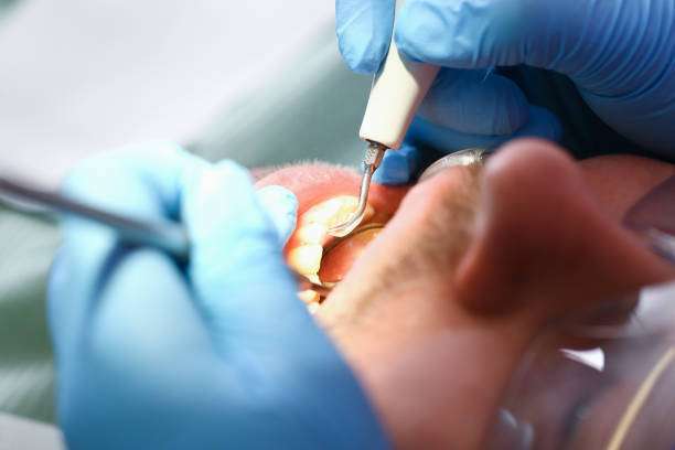 Emergency Dental Filling Replacement in MN